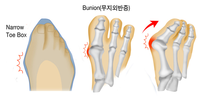 Narrow Toe Box, Bunion(무지외반증)