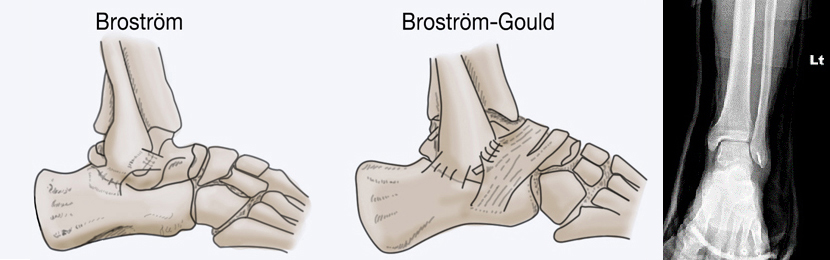 Brostrom, Brostrom-Gould