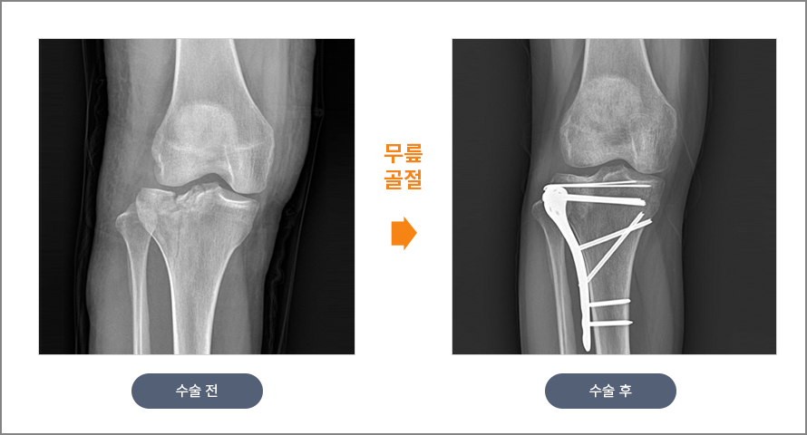 무릎 골절 수술 전후