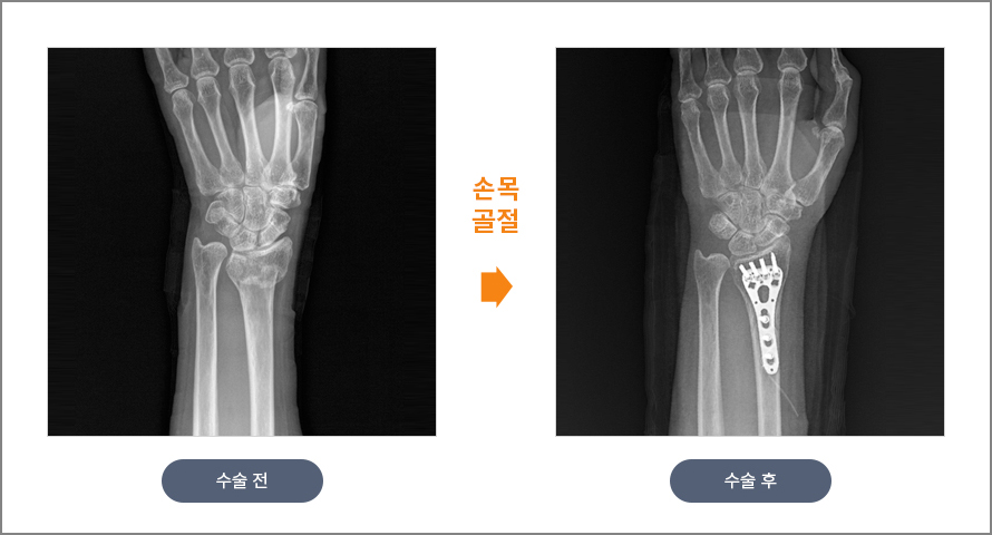 손목 골절 수술 전후