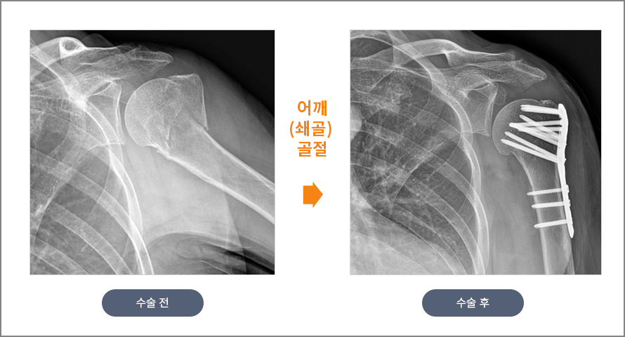 어깨(쇄골) 골절 수술 전후