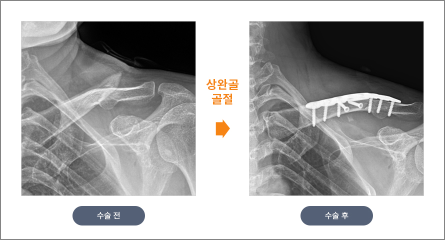 상완골 골절 수술 전후