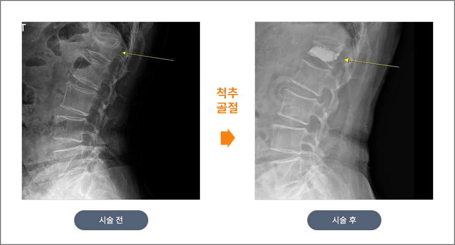 척추 골절 수술 전후