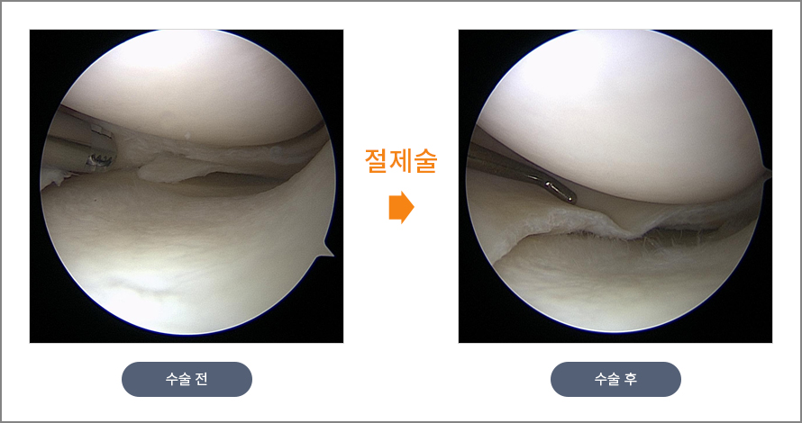 절제술 수술 전후