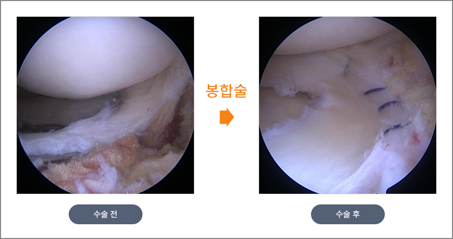 봉합술 수술 전후