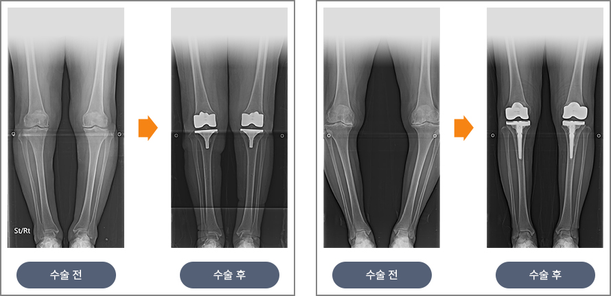 수술 전후